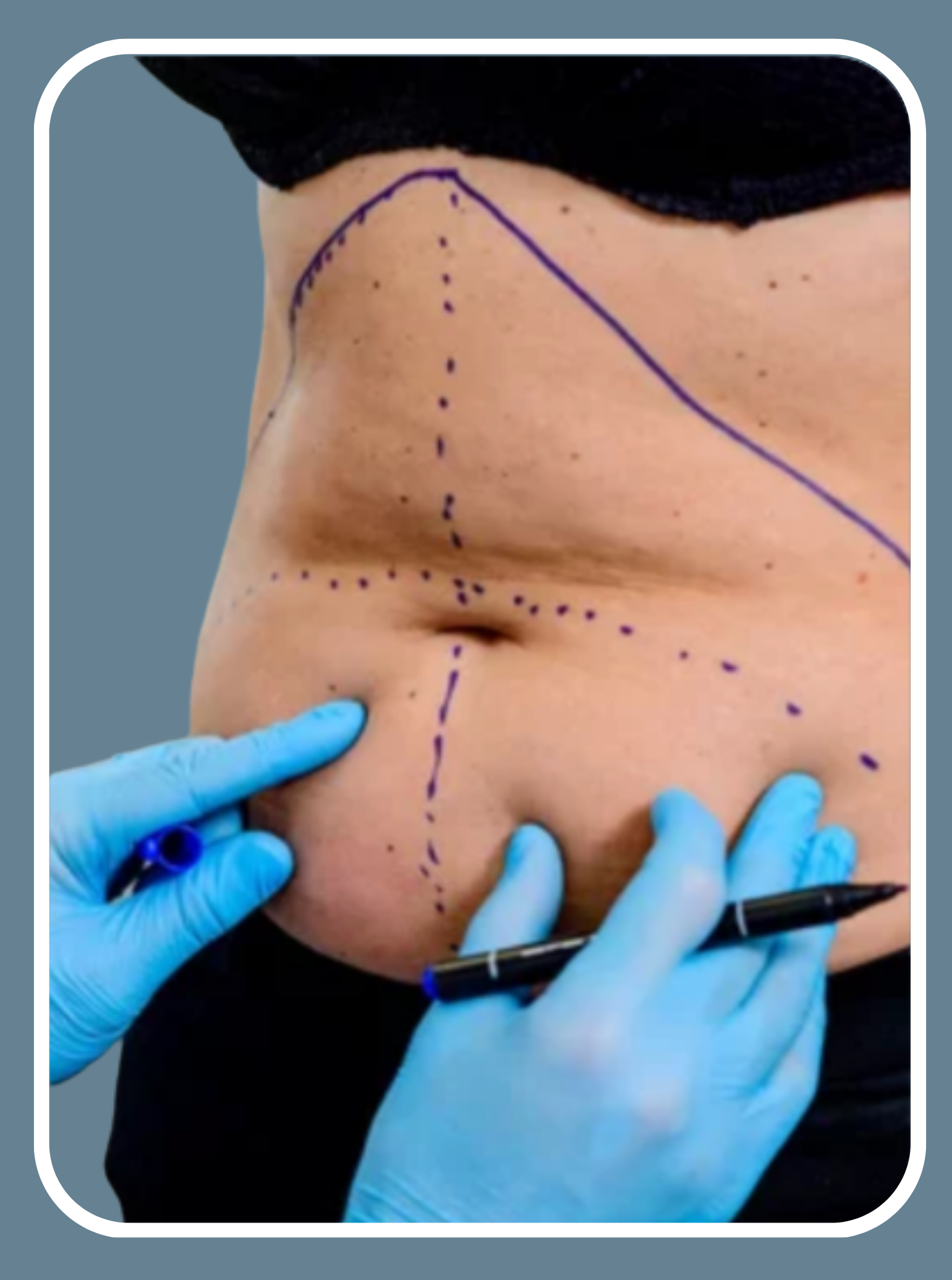 Body Contouring 